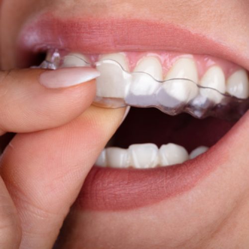 Close-up Of A Woman's Hand Putting Transparent Aligner In Teeth